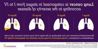 This animated graphic explains the differences between the two main forms of lung cancer, and how the two main forms of lung cancer are staged.